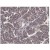 Breast CA section stained with Autophagy Beclin-1 antibody Cat.-No AM32462SU-N (Clone 15CT26) at 1/50 dilution. Data courtesy of Dr. Anita Thyagarajan, Cancer Research Laboratory, Methodist Research Institute, Indianapolis, Indiana.