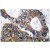 Immunohistochemistry analysis of HSP105 antibody Cat.-No AP06171PU-N antibody in paraffin-embedded human colon carcinoma tissue.