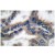 Immunohistochemistry analysis of DNAJB1 / HSP40 Antibody Cat.-No AP06173PU-N in paraffin-embedded lung carcinoma tissue.
