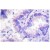 Immunohistochemistry analysis of PP2A-alpha antibody Cat.-No AP06572PU-N in Paraffin-Eembedded
Human lung carcinoma tissue.