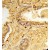 Formalin-fixed and paraffin-embedded human prostate carcinoma reacted with 17-beta HSD6 / HSD17B6 Antibody (N-term) Cat.-No AP52113PU-N, which was peroxidase-conjugated to the secondary antibody, followed by DAB staining.