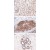 Formalin-fixed and paraffin-embedded human neurofibroma tissue ( A; 4 µm ) , skin melanoma tissue ( B; 4 µm ) , and human breast tissue ( C; 4 µm ) stained with S100A1 monoclonal antibody, clone D28-E ( Cat # MAB1659 ) show: A - positive immunostaining of tumor cells and peripheral nerve; B - strong positive immunostaining of melanoma cells; C - strong positive immunostaining of the outer myoepithelial cell component in mammary lobule. Kindly performed and provided by Katarina Poliakova, MD and Lubomir Straka, MD, Ph. D., from Clinical Pathology Presov, Ltd., Presov, Slovakia.