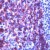 Immunohistochemical staining of KRT5 on formalin fixed, paraffin embedded human mesothelioma with KRT5 monoclonal antibody, clone SP27.