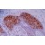 Immunohistochemistry staining of human skin basaliom ( paraffin-embedded sections ) with KRT10 monoclonal antibody, clone VIK-10 ( Cat # MAB3663 ).