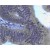 Immunohistochemistry: MMP-3 Antibody (SB14d) [NBP1-28615] - 5 ug/mL Paraffin embedded sections of human colon carcinoma were stained with MMP-3. Goat Anti-Mouse IgG2a, human ads-BIOT and Streptavidin-HRP were used and then developed with DAB.