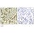 Immunohistochemistry: AKT1/AKT2 Antibody [NBP1-04946] - Immunohistochemical analysis of paraffin-embedded human breast carcinoma tissue  using AKT1/AKT2 (Ab-308/309) Antibody