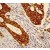 Immunohistochemistry: Cytokeratin 18 Antibody (E431-1) [NB110-56910] - Immunohistochemical analysis of paraffin-embedded colon carcinoma using anti-Keratin 18 (catalog #110-56910).