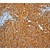 Immunohistochemistry: Cytokeratin 19 (C-term) Antibody (EP1580Y) [NB110-56914] - Immunohistochemical staining of paraffin-embedded human kidney carcinoma using anti-CK-19.
