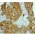 Immunohistochemistry: Cytokeratin 8 Antibody (EP1628Y) [NB110-56919] - Analysis of paraffin-embedded human breast adenocarcinoma using anti-CK8 (cat. #110-56919).
