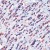 Formalin-fixed, paraffin-embedded human breast carcinoma stained with Heat Shock Protein 60 (Cat. #NB600-1195) using peroxidase-conjugate and AEC chromogen. Note intense cytoplasmic staining of tumor cells.