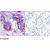 Immunohistochemistry: BCL-XL Phosphospecific Antibody [NB100-81814] - Immunohistochemical analysis of paraffin-embedded human breast carcinoma tissue using BCL-XL (phospho-Ser62) antibody NB100-81814