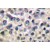 Immunohistochemistry: MMP-14 Antibody [NB100-91872] - Immunohistochemistry  (IHC)  analyzes of MMP-14  (P509) antibody in paraffin-embedded human breast  carcinoma tissue