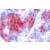 Immunohistochemistry: STAT4 Phosphospecific Antibody [NB100-92640] - Immunohistochemistry (IHC) analyzes of p-STAT4  (Y693) antibody in paraffin-embedded human breast  carcinoma tissue.