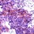 Immunohistochemical staining of AKT1/AKT2 on formalin fixed, paraffin embedded human lung carcinoma with AKT1/AKT2 polyclonal antibody.
