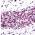 Immunohistochemical staining of AKT1 on formalin fixed, paraffin embedded human breast carcinoma with AKT1 polyclonal antibody.