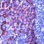 Immunohistochemical staining of KRT5 on formalin fixed, paraffin embedded human mesothelioma with KRT5 polyclonal antibody.