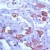 Immunohistochemical staining of KRT8 on formalin fixed, paraffin embedded human lung with KRT8 polyclonal antibody.