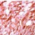 Immunohistochemical staining of S100A1 on formalin fixed, paraffin embedded human melanoma with S100A1 polyclonal antibody.