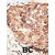 Formalin-fixed and paraffin-embedded human cancer tissue reacted with STAT5B polyclonal antibody ( Cat # PAB3577 ) , which was peroxidase-conjugated to the secondary antibody, followed by DAB staining. This data demonstrates the use of this antibody for immunohistochemistry ; clinical relevance has not been evaluated. BC = breast carcinoma.
