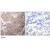 Imunohistochemical analysis of paraffin-embedded human breast carcinoma tissue, using KRT18 polyclonal antibody ( Cat # PAB7684 ).