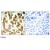 Imunohistochemical analysis of paraffin-embedded human breast carcinoma tissue, using KRT8 polyclonal antibody ( Cat # PAB7685 ).