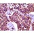Immunohistochemical of  paraffin-embedded Lung cancer using 65044-1-Ig(BLK Antibody) at Dilution 1:100