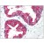 Formalin-Fixed, Paraffin-Embedded Human prostate stained with Cytokeratin 8 antibody Cat.-No SM3079P followed by biotinylated Horse anti-Mouse IgG secondary antibody, alkaline phosphatase-streptavidin and chromogen.