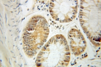 Fig. 6: <span>Immunohistochemistry of paraffin-embedded Colon cancer using 10571-1-AP(CCT3 Antibody) at Dilution 1:50 (under 10x lens)</span> Fig. 6: <span>Immunohistochemistry of paraffin-embedded Colon cancer using 10571-1-AP(CCT3 Antibody) at Dilution 1:50 (under 10x lens)</span>