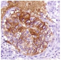 Fig. 4: Human lung carcinoma stained with anti-GLUT1 antibody. Fig. 4: Human lung carcinoma stained with anti-GLUT1 antibody.