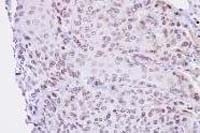 Fig. 8: Immunohistochemistry: Lamin B2 antibody Cat.-No. AP19033PU-N staining of paraffin-embedded Cal27 xenograft at 1/100 dilution