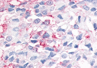 Fig. 8: Human breast carcinoma (FFPE) staining with ESRRG antibody Cat.-No. SP4133P