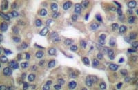 Fig. 1: Formalin-fixed, paraffin-embedded (FFPE) human breast carcinoma tissue stained with GRP78 antibody Cat.-No. AP06149PU-N