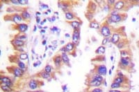 Fig. 6: Human lung carcinoma tissue (FFPE) stained with calnexin antibody Cat.-No. AP06425PU-N