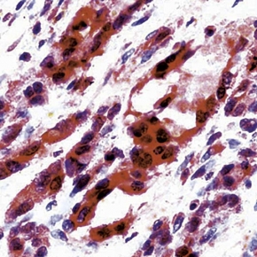 Fig. 5: Formalin fixed paraffin embedded (FFPE) human angiosarcoma stained with VEGFR-2/Flk-1 antibody Cat.-No. DP076-05 Fig. 5: Formalin fixed paraffin embedded (FFPE) human angiosarcoma stained with VEGFR-2/Flk-1 antibody Cat.-No. DP076-05