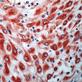 Fig. 6: Human placenta (FFPE) stained with anti-VEGFR-3/Flt-4 antibody Cat.-No. AP15558PU-N Fig. 6: Human placenta (FFPE) stained with anti-VEGFR-3/Flt-4 antibody Cat.-No. AP15558PU-N