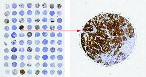 Breast carcinoma tissue microarray (Cat.-No. TMA-049) examined using an antibody to human HER2/neu protein