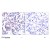 Figure 1. Immunohistochemical analysis of paraffin-embedded human breast carcinoma using JunB (phospho-Ser259) antibody.