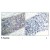 Figure 1. Immunohistochemical analysis of paraffin- embedded human breast carcinoma tissue using LIMK2 (phospho-Thr505) antibody (#AP02415PU).