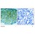 Immunohistochemical analysis of paraffin-embedded human breast carcinoma tissue, using PAK1 antibody AP02681PU.