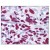 Figure 1. Staining GLI3 in Brain, Glioblastoma by Immunohistochemistry using Formalin-Fixed Paraffin-Embedded (FFPE) tissue.