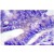 Immunohistochemistry (IHC) analyzes of eIF4B pSer422 antibody (Cat.-No.: AP01821PU-N) in paraffin-embedded human colon carcinoma tissue.