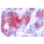 Immunohistochemistry (IHC) analyzes of STAT4 pTyr693 antibody (Cat.-No.: AP01694PU-N) in paraffin-embedded human breast carcinoma tissue.