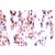 Immunohistochemistry (IHC) analysis of JunB pSer79 antibody (Cat.-No.: AP01623PU-N) in paraffin-embedded human breast carcinoma tissue.