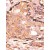 Formalin-fixed and paraffin-embedded human cancer tissue reacted with the primary antibody, which was peroxidase-conjugated to the secondary antibody, followed by AEC staining