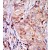 Formalin-fixed and paraffin-embedded human cancer tissue reacted with the primary antibody, which was peroxidase-conjugated to the secondary antibody, followed by AEC staining.
