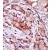 Formalin-fixed and paraffin-embedded human cancer tissue reacted with the primary antibody, which was peroxidase-conjugated to the secondary antibody, followed by AEC staining.