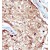 Formalin-fixed and paraffin-embedded human cancer tissue reacted with the primary antibody, which was peroxidase-conjugated to the secondary antibody, followed by AEC staining.