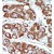 Formalin-fixed and paraffin-embedded human cancer tissue reacted with the primary antibody, which was peroxidase-conjugated to the secondary antibody, followed by DAB staining.
