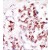 Formalin-fixed and paraffin-embedded human cancer tissue reacted with the primary antibody, which was peroxidase-conjugated to the secondary antibody, followed by DAB staining.