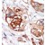 Formalin-fixed and paraffin-embedded human cancer tissue reacted with the primary antibody, which was peroxidase-conjugated to the secondary antibody, followed by DAB staining.